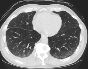 000 Reticular Pattern Reticulation | Lungs