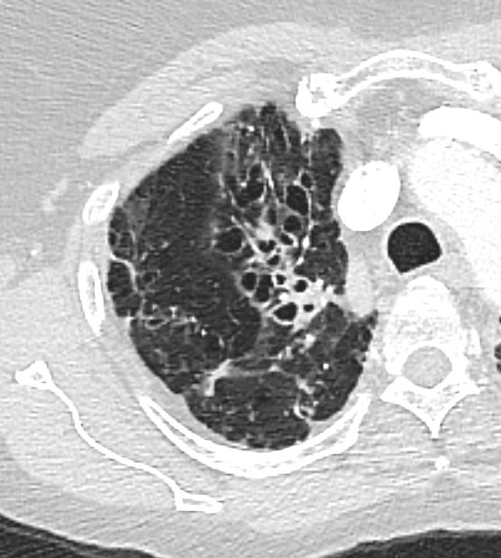 Bronchiectasis Imaging: Practice Essentials, Radiography, Computed  Tomography