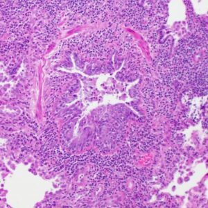 000 Follicular Bronchiolitis | Lungs