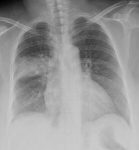 CXR Consolidation Infiltrate | Lungs