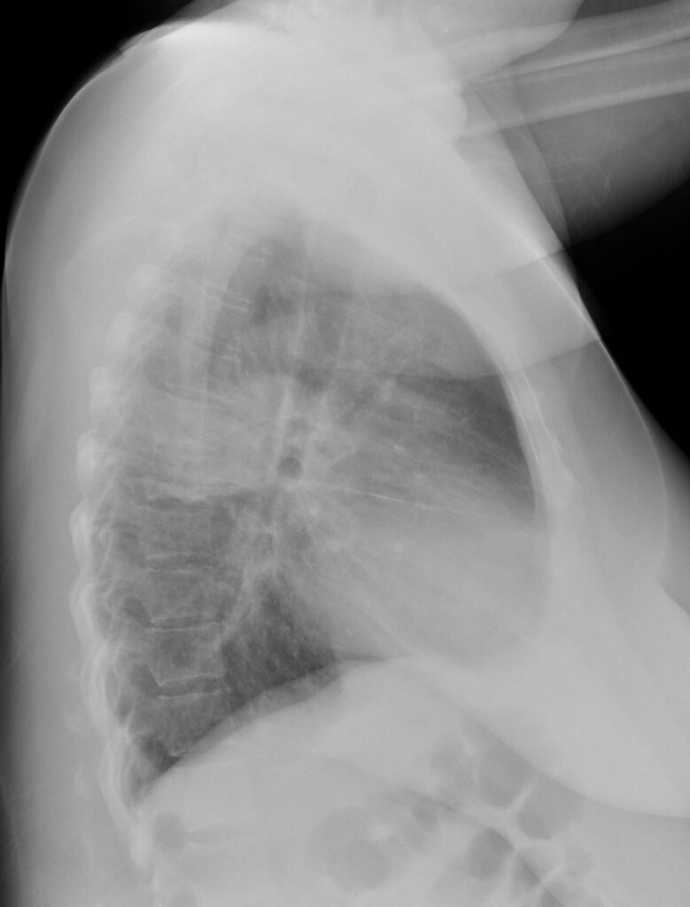 CXR Consolidation Infiltrate | Lungs