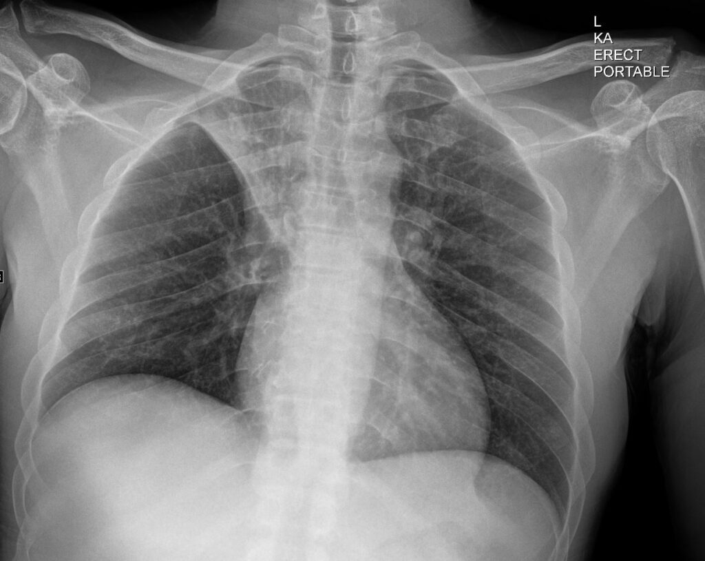 186Lu Right Upper Lobe Collapse | Lungs