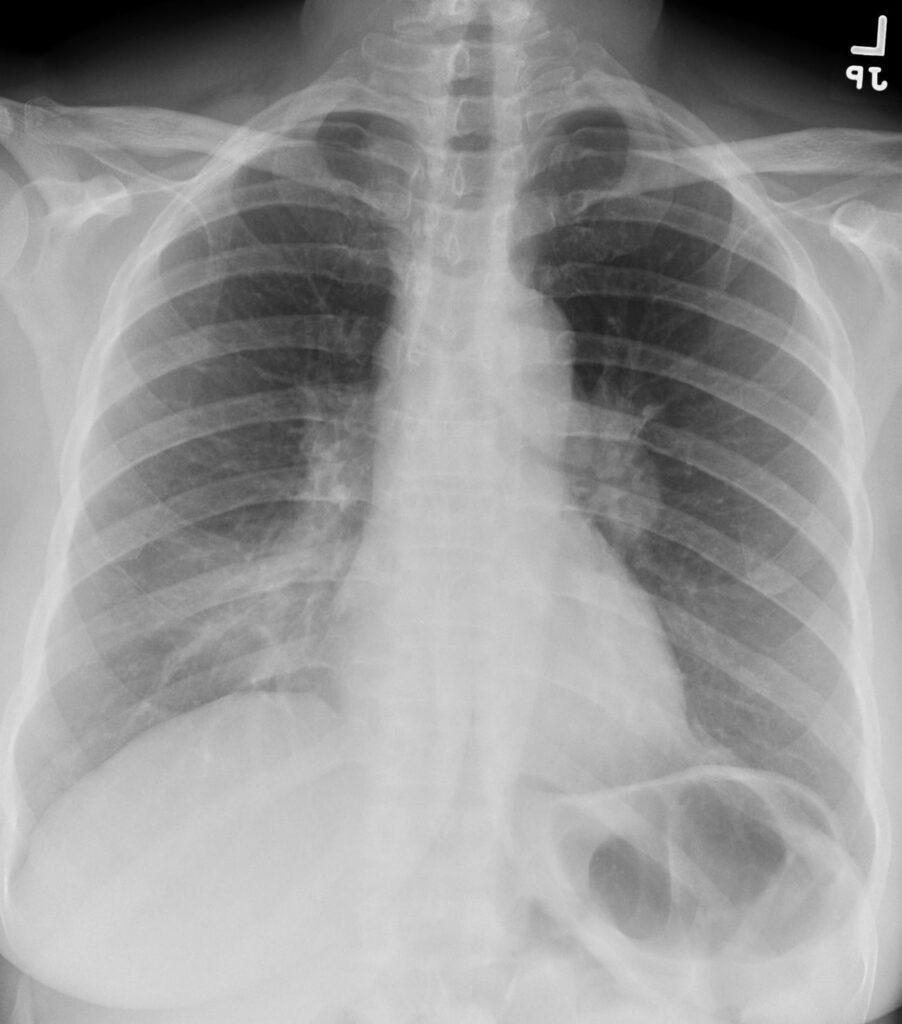 180Lu Sarcoidosis Lymphadenopathy and Atelectasis | Lungs