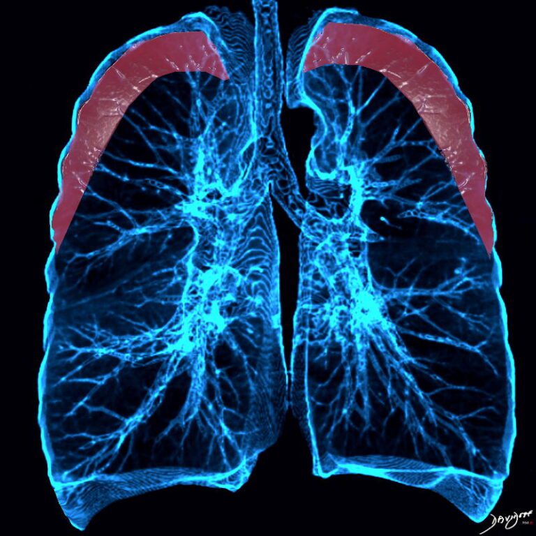 Faces of Chronic Eosinophilic Pneumonia | Lungs