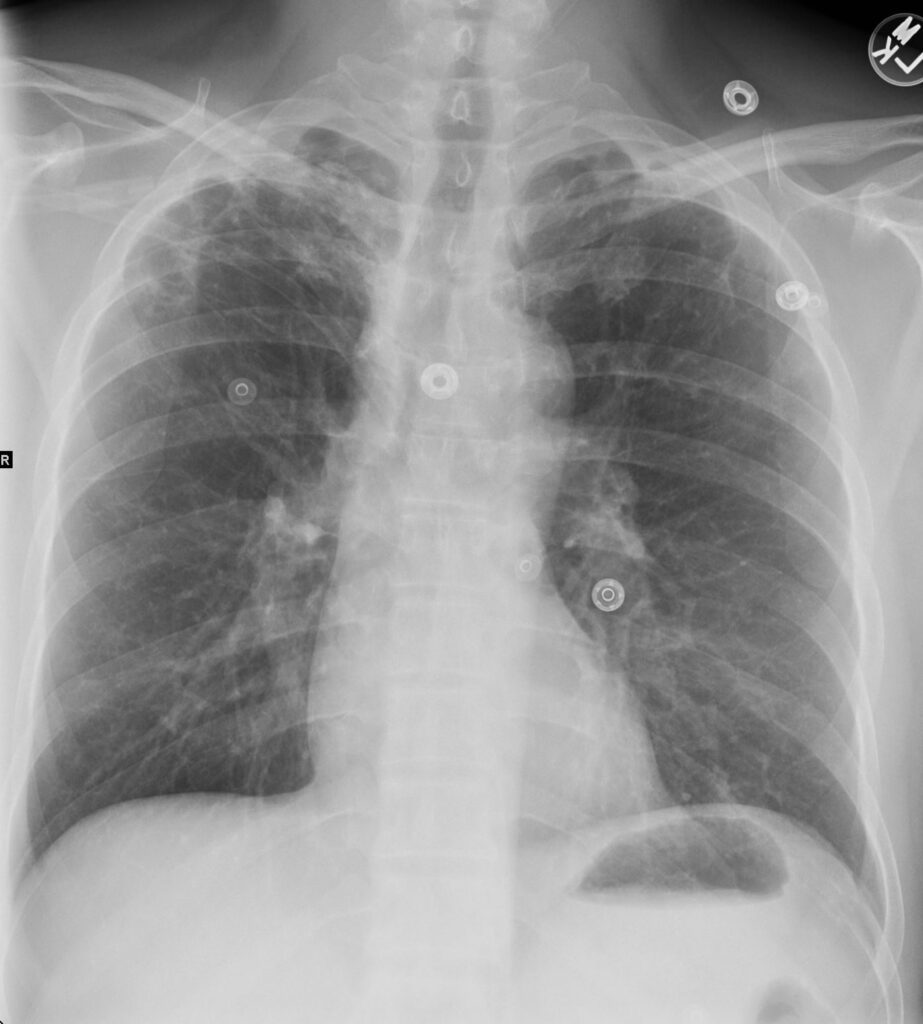 182Lu Latent TB Apical retraction | Lungs