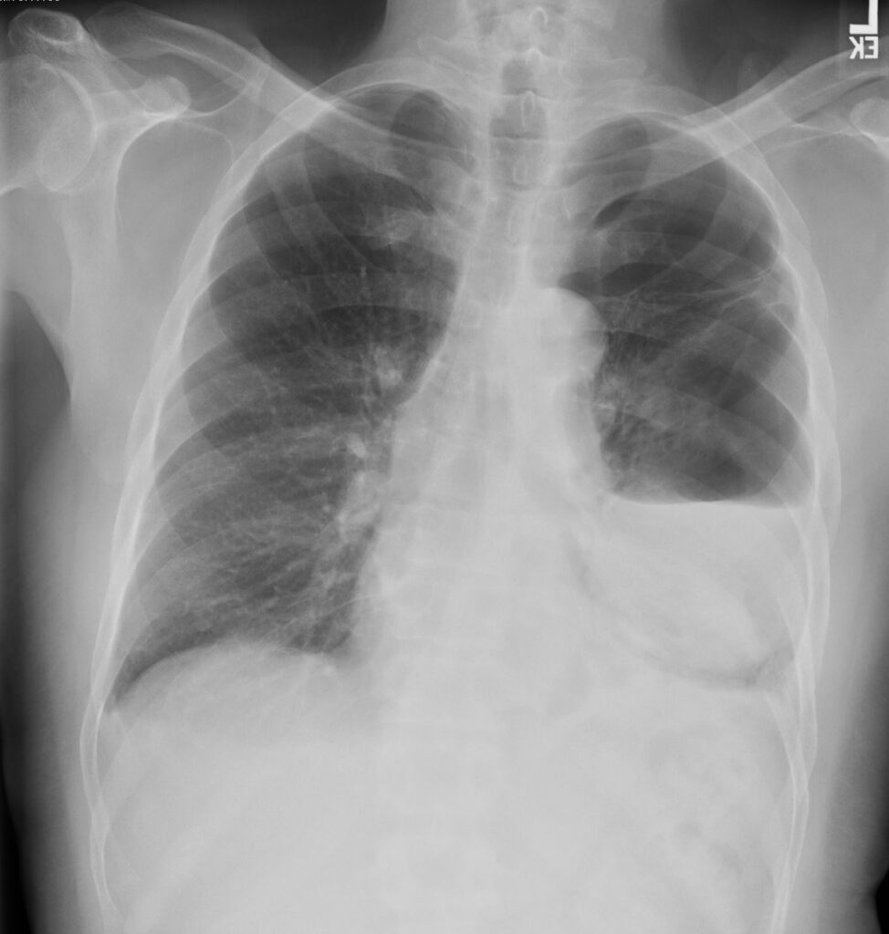 184Lu Spontaneous Rupture of Bulla with Hydropneumothorax | Lungs