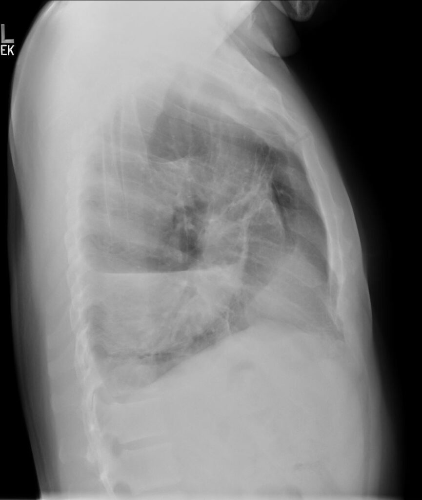 184Lu Spontaneous Rupture of Bulla with Hydropneumothorax | Lungs