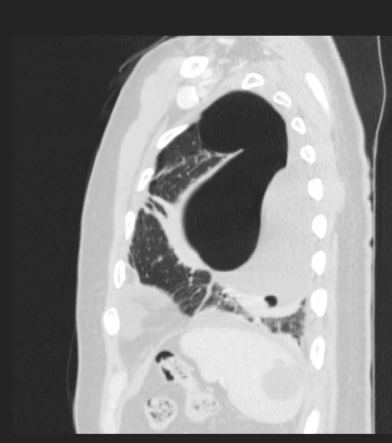 184lu Spontaneous Rupture Of Bulla With Hydropneumothorax Lungs