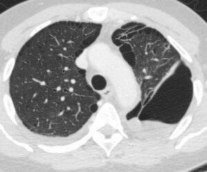 184Lu Spontaneous Rupture of Bulla with Hydropneumothorax | Lungs