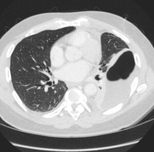 184Lu Spontaneous Rupture of Bulla with Hydropneumothorax | Lungs