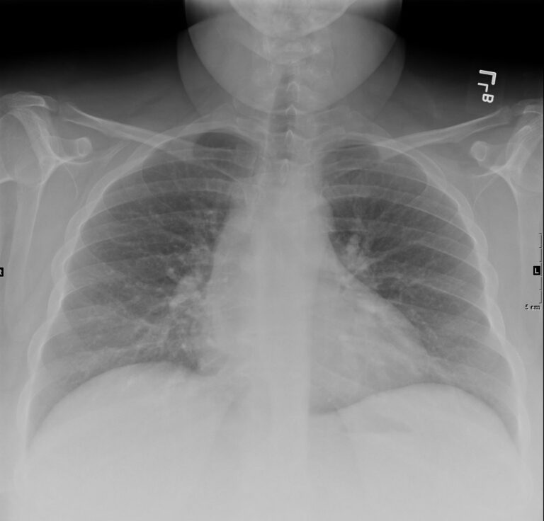 171Lu Acute Inhalational Crack Injury | Lungs