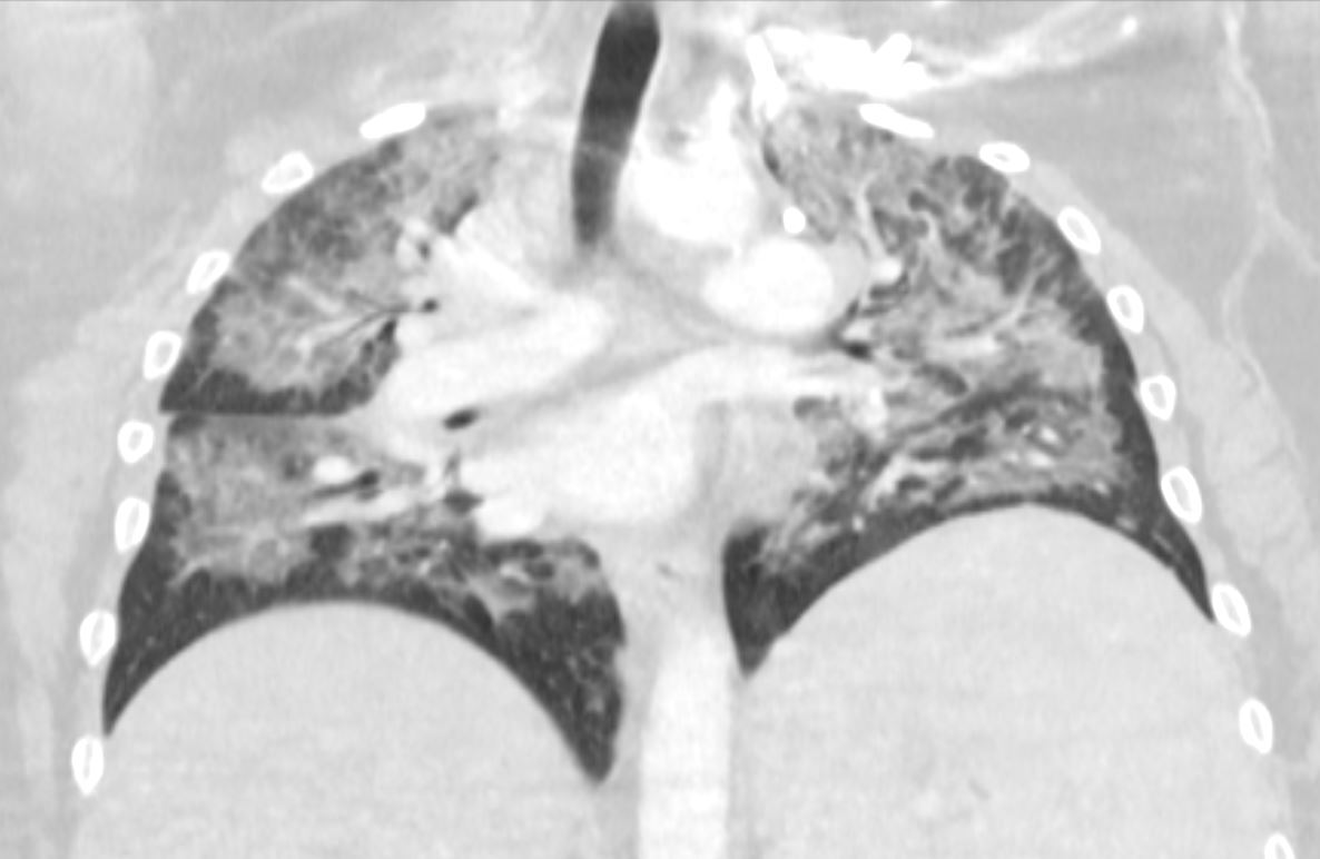 171Lu Acute Inhalational Crack Injury | Lungs