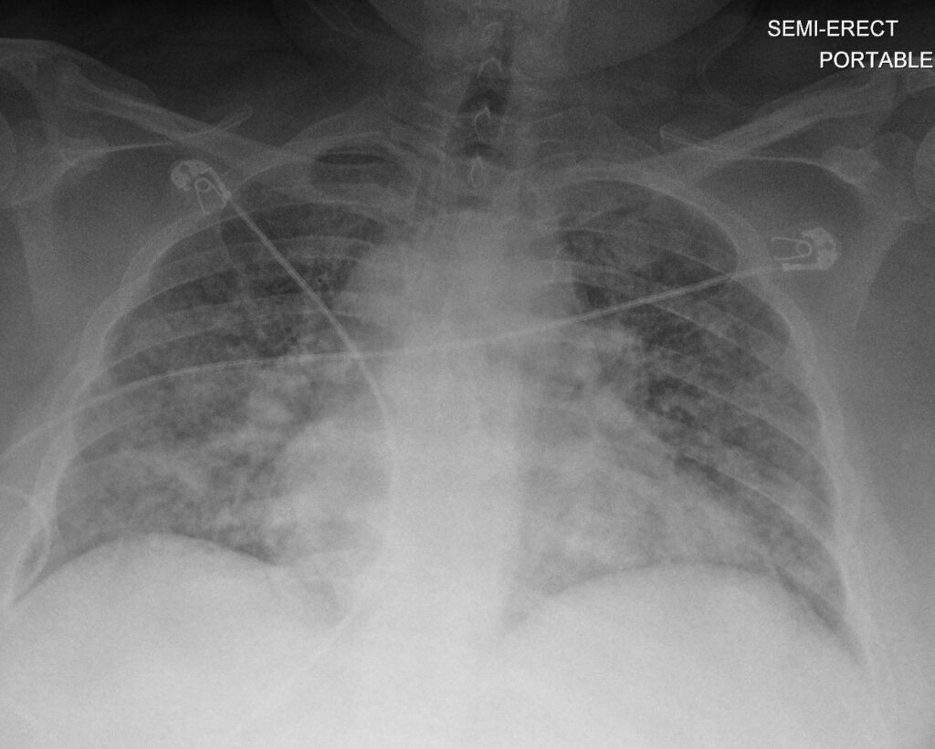 171Lu Acute Inhalational Crack Injury | Lungs