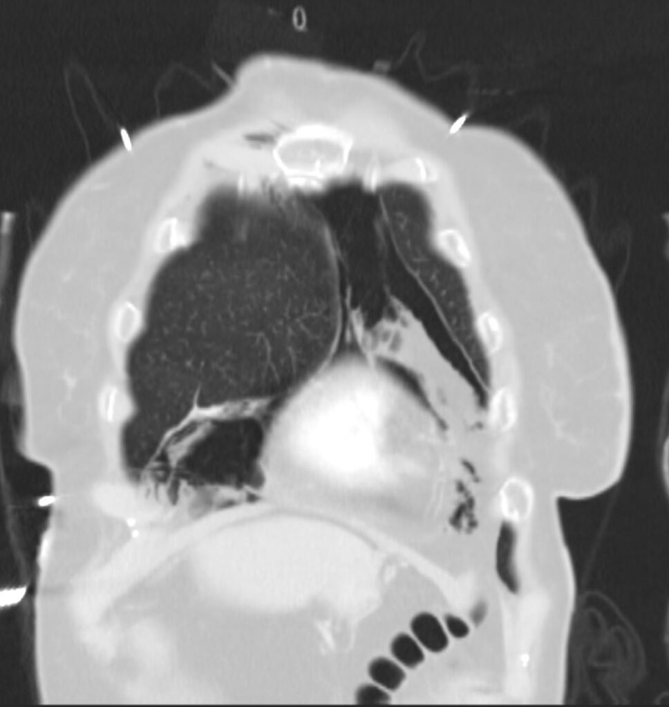 000 Pneumomediastinum | Lungs