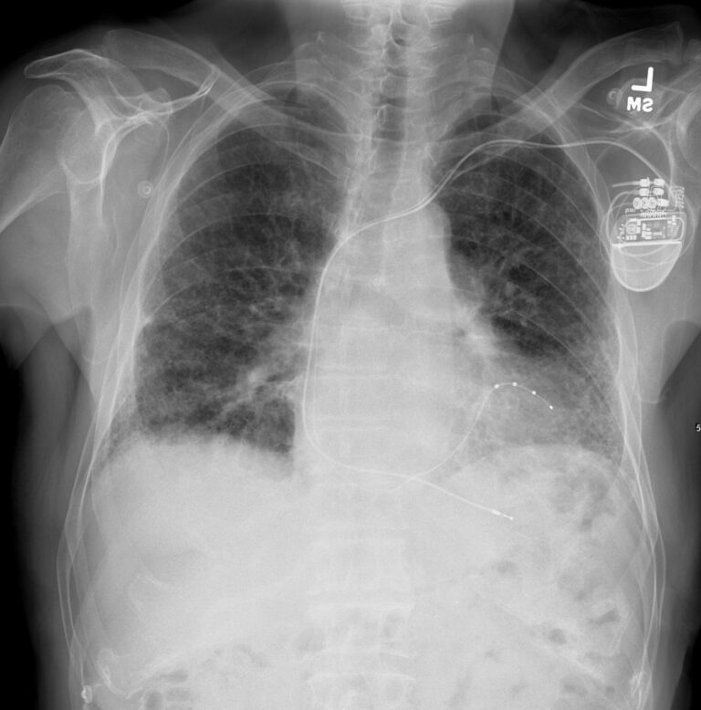 000 Reticular Pattern Reticulation | Lungs