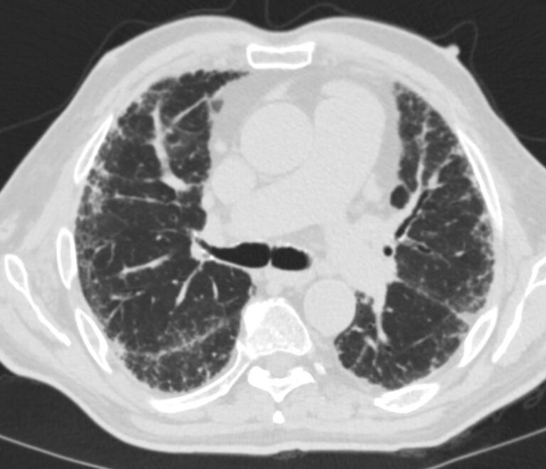 000 Reticular Pattern Reticulation | Lungs