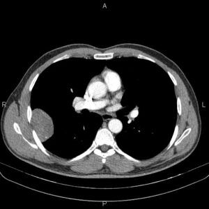 000 Solitary Fibrous Tumor (sft) Benign Fibrous Mesothelioma 