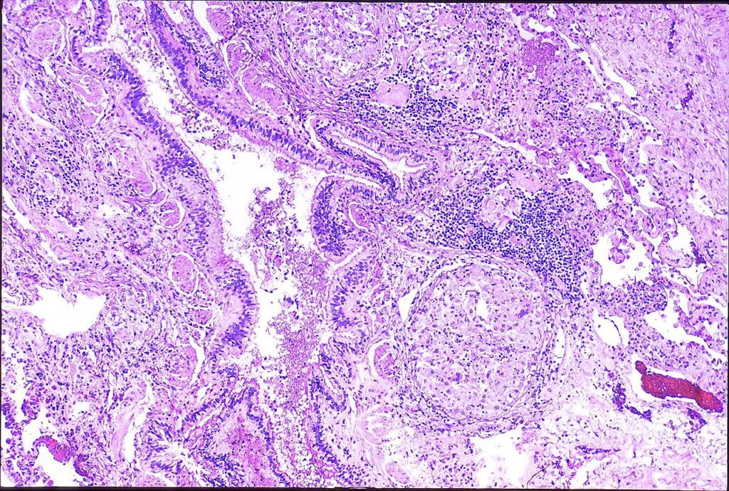 000 Berylliosis | Lungs