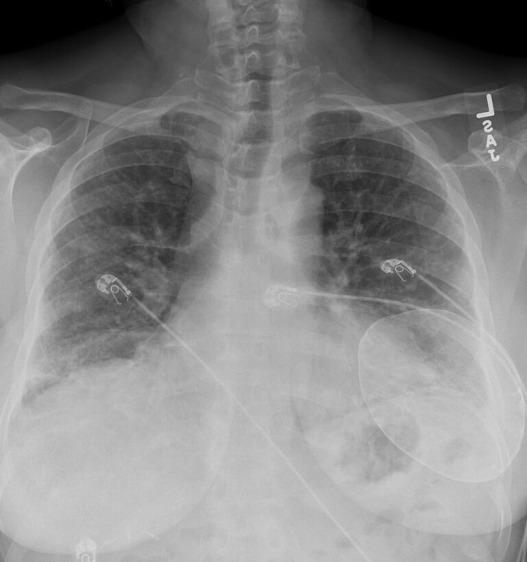 197Lu SLE NSIP probable Fibrotic Pattern | Lungs