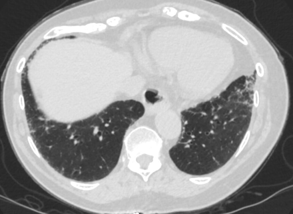 198lu Scleroderma Early Nsip Mild Over 3 Years 