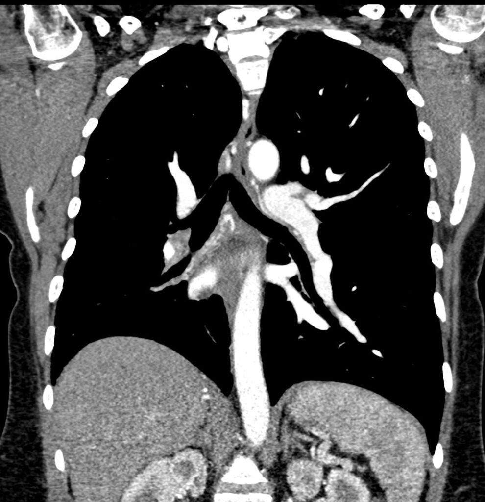 202Lu Absent Right Branch Pulmonary Arteries | Lungs