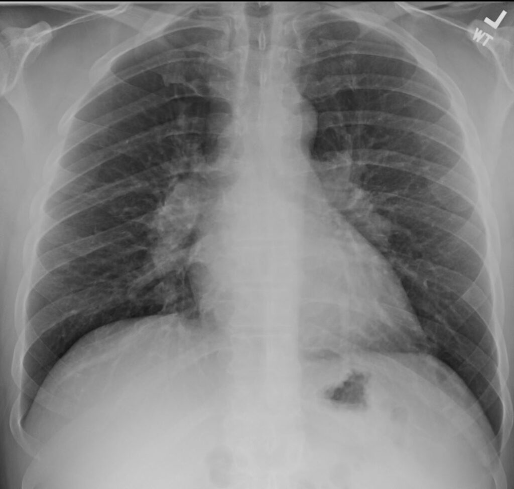 208Lu Sarcoidosis Lymphadenopathy and Broncho-vascular Granulomas | Lungs