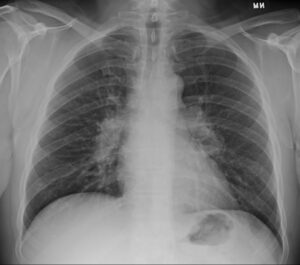 208Lu Sarcoidosis Lymphadenopathy and Broncho-vascular Granulomas | Lungs