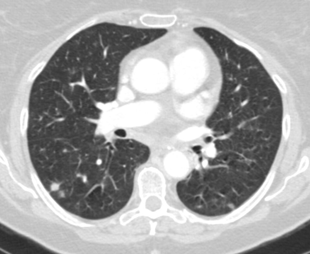 209Lu Necrotizing Granuloma PET Positive Bronchocentric Granulomatosis ...