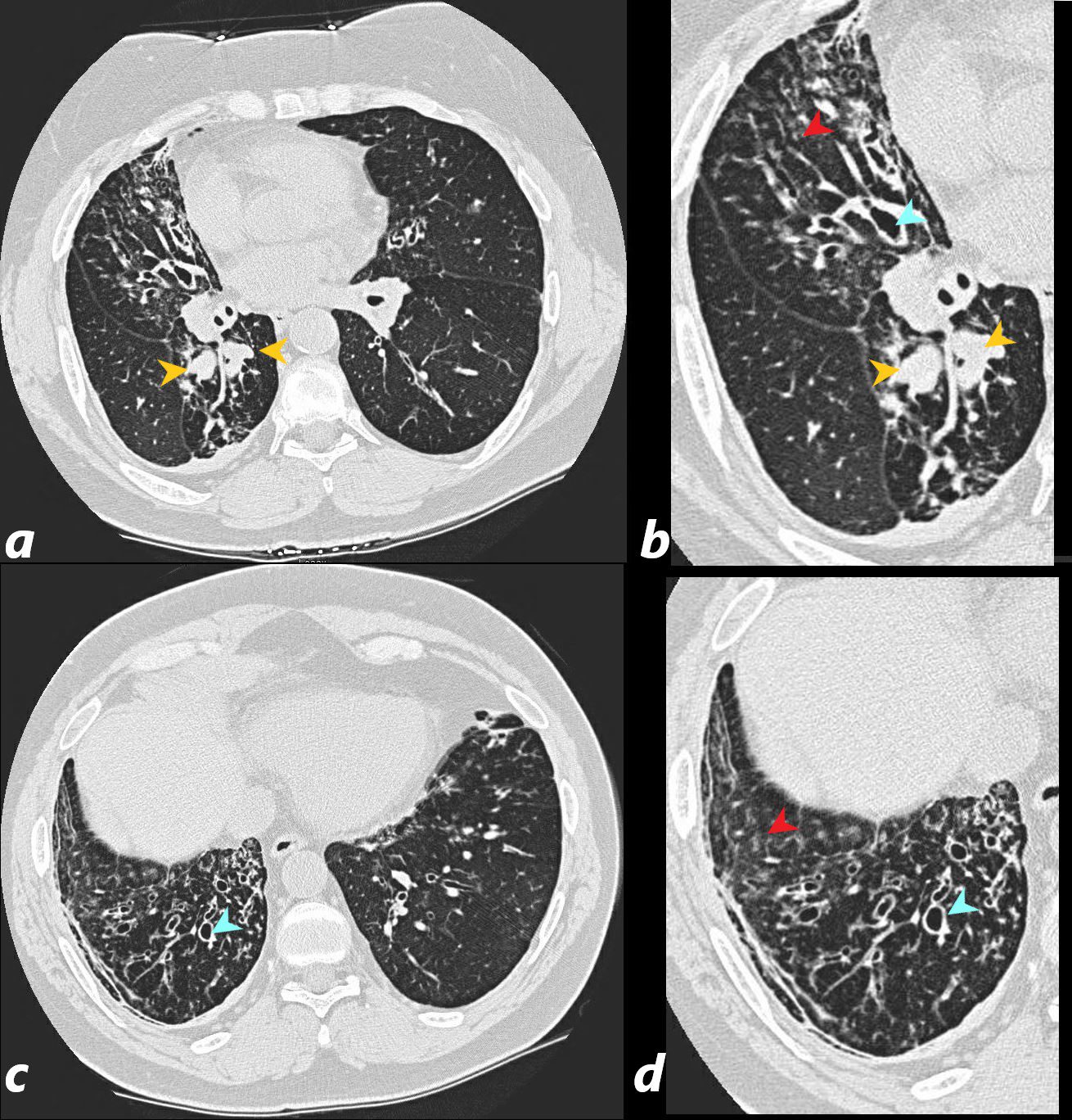 Invasive pulmonary aspergillosis 10 years post bone marrow transplantation:  a case report | Journal of Medical Case Reports | Full Text