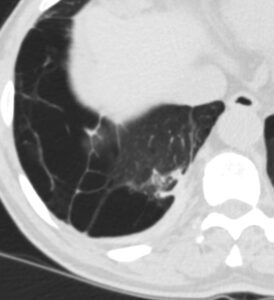 000 Atelectasis Rounded | Lungs