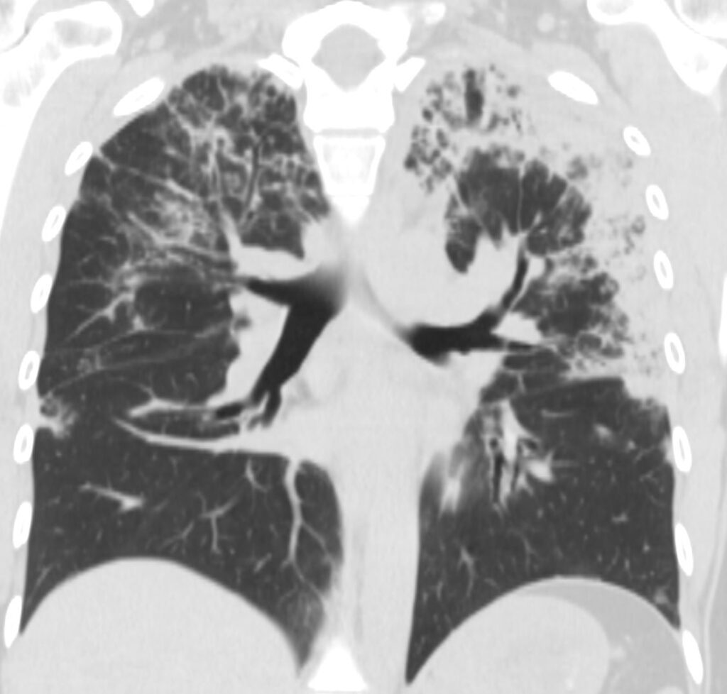 Faces of Chronic Eosinophilic Pneumonia | Lungs