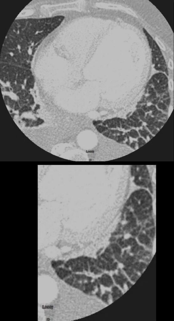 WF Interlobular Septal Thickening | Lungs