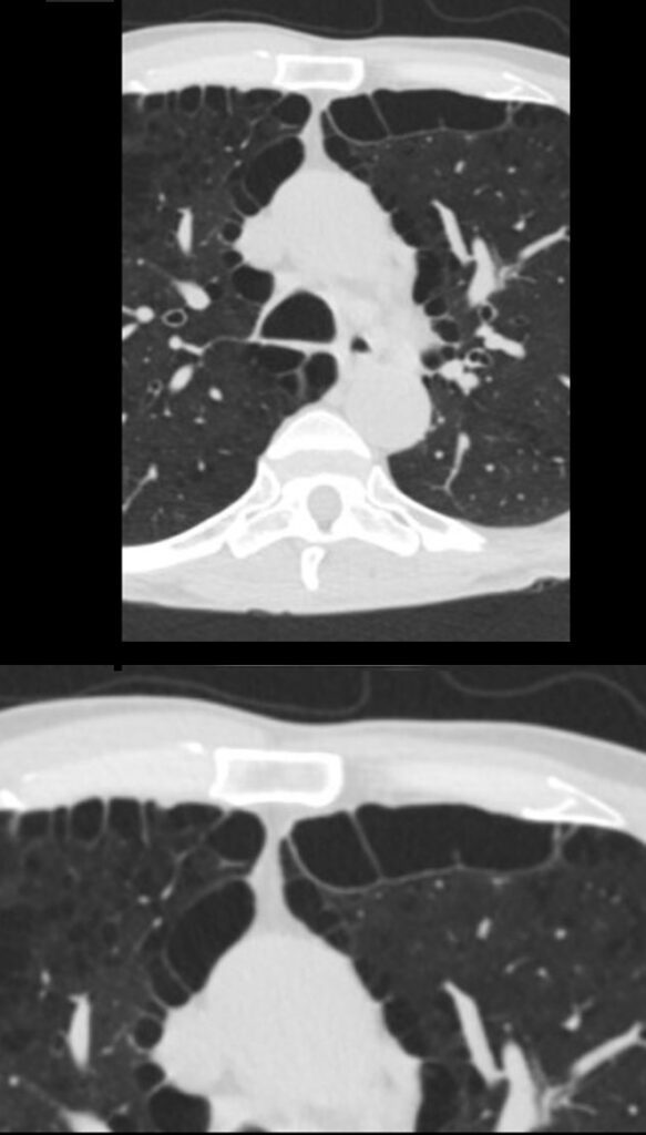 wf-paraseptal-emphysema-lungs