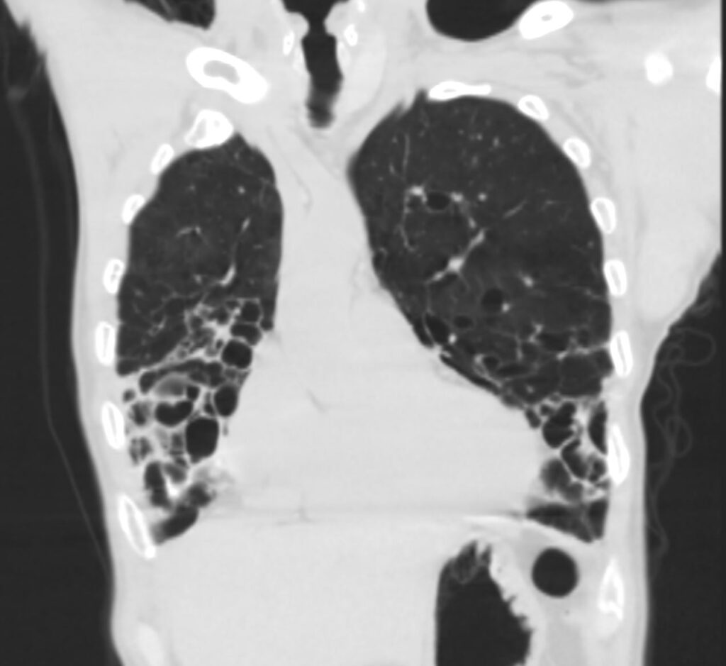 Image: Bronchiectasis (Computed Tomography) - MSD Manual Professional  Edition