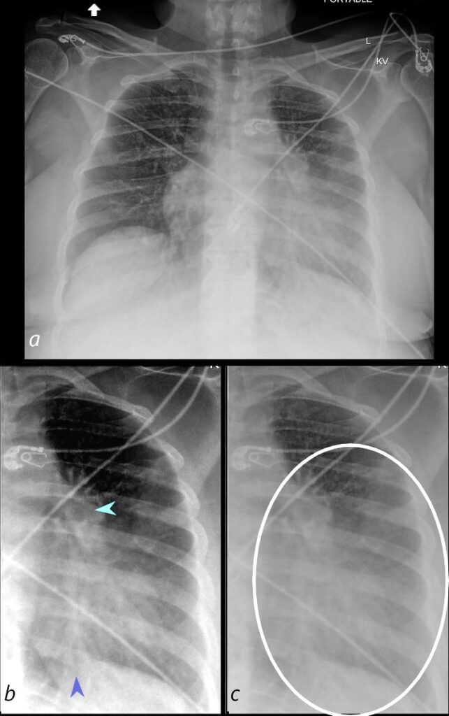 Faces Of Atelectasis Shape Lungs