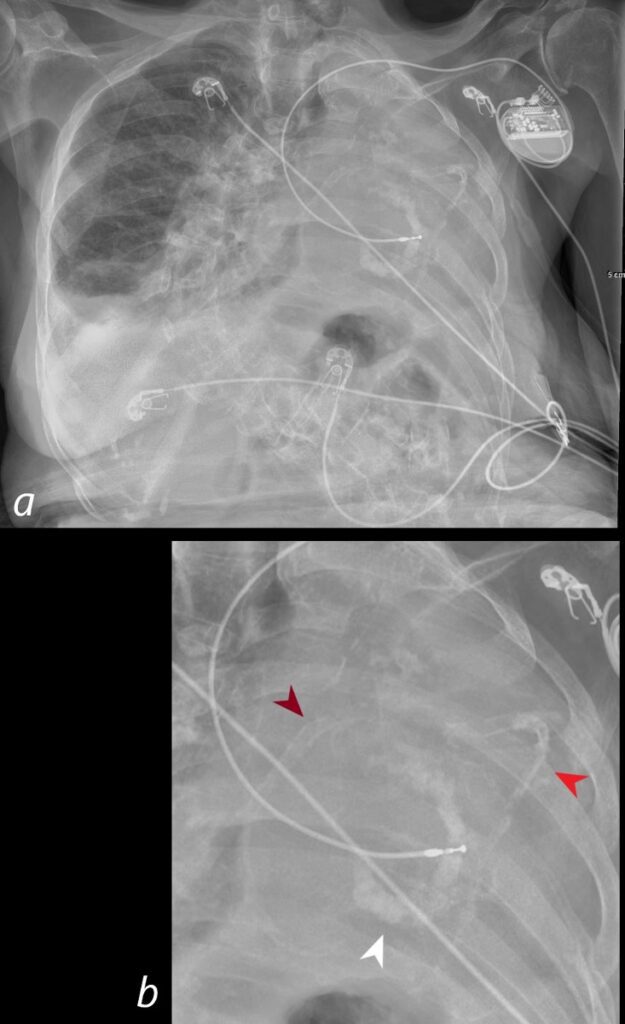 Faces Of Calcification 