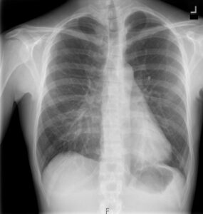 000 Pectus Excavatum | Lungs