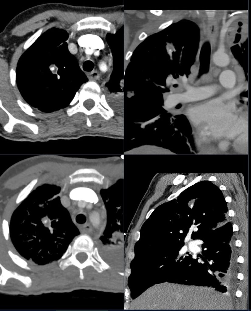 Faces of Emboli | Lungs